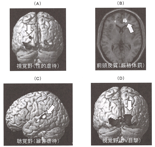 図1　児童虐待経験者の脳皮質容積変化