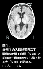 図１．症例１の入院時頭部CT／両側の硬膜下血腫（矢印）と前頭部〜側頭部のくも膜下腔拡大（矢頭）を認める．R：右，Ｌ：左．