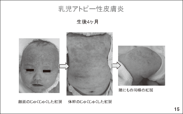 スライド15.乳児アトピー性皮膚炎